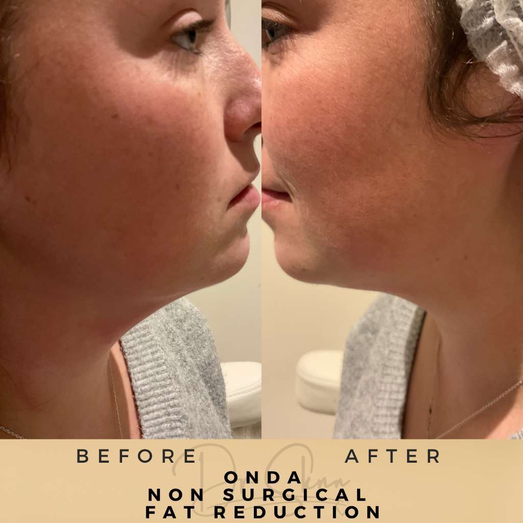 【極美品】Non-Surgical Skin Tightening and Li 極美品】Non-Surgical Skin Tightening and Li 極美品】Non-Surgical